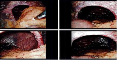 Transoral incisionless fundoplication and open hiatal hernia repair: A case report